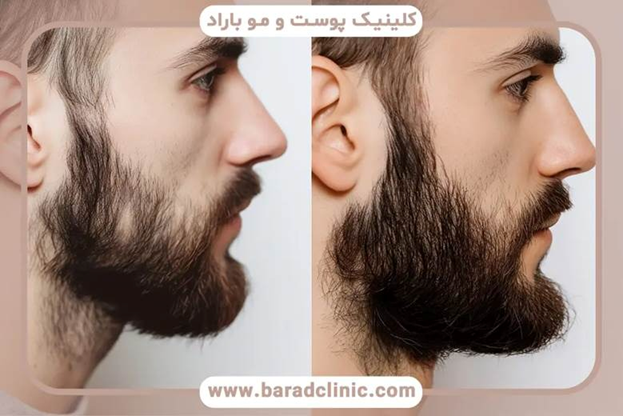 یکی از مراحل مهم قبل از کاشت ریش
