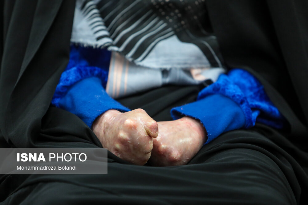 بازدید وزیر خارجه از خانه بیماران پروانه‌ای