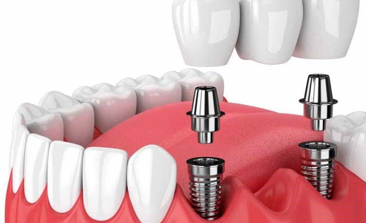 مزایا و معایب ایمپلنت دندان چیست؟