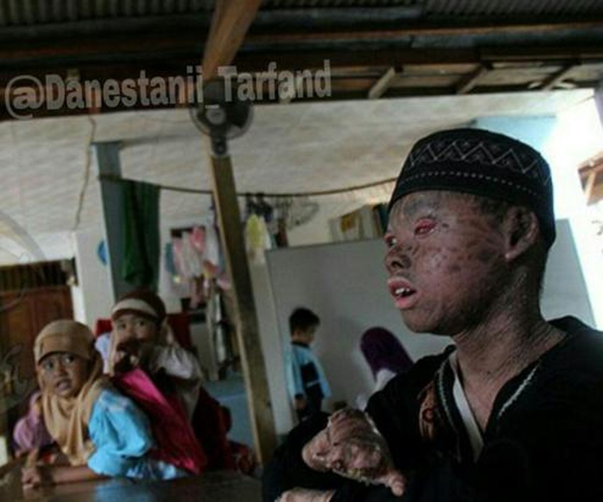 عکس وحشتناک از پسر مارمولکی