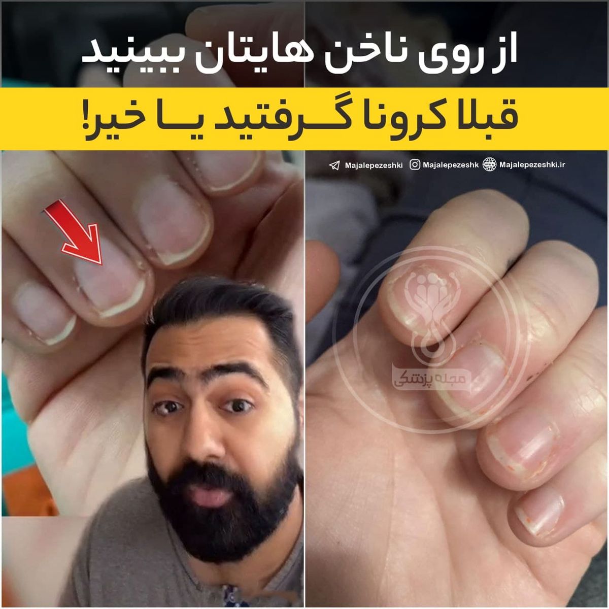 ادعای عجیب یک پزشک؛ از روی ناخنهایتان ببینید قبلاً کرونا گرفتید یا خیر ؟! +عکس