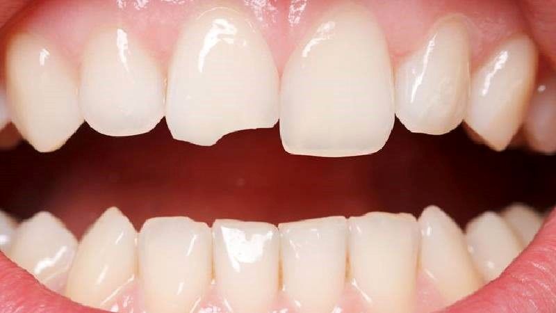 آیا روکش لمینت دندان به راحتی می ریزد؟ + مشاوره رایگان