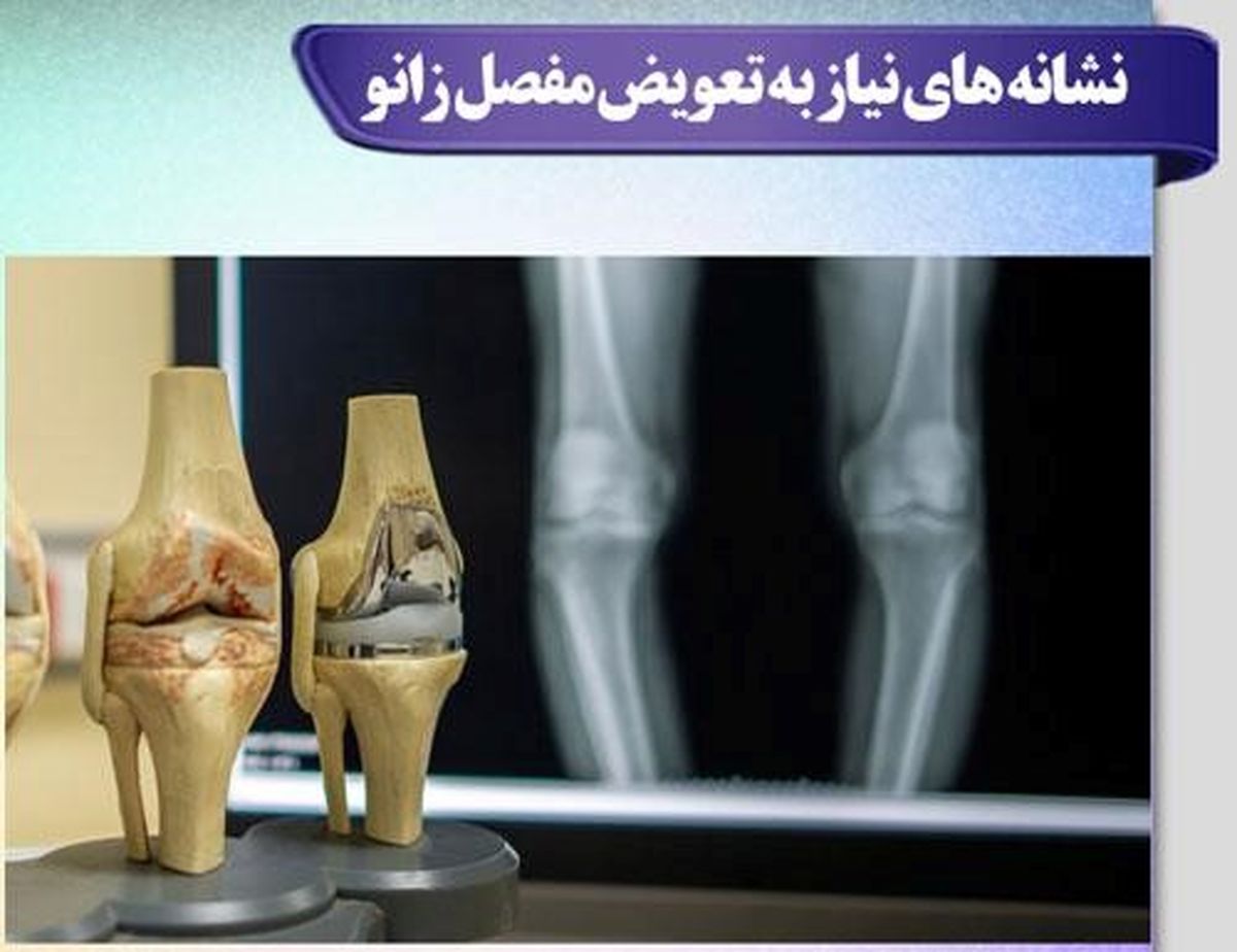 راهنمای کامل عمل تعویض مفصل زانو