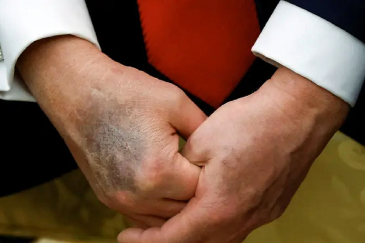 پزشکان ایرانی بیماری واقعی ترامپ را فاش کردند | بیماری جذام شایعه یا واقعیت؟