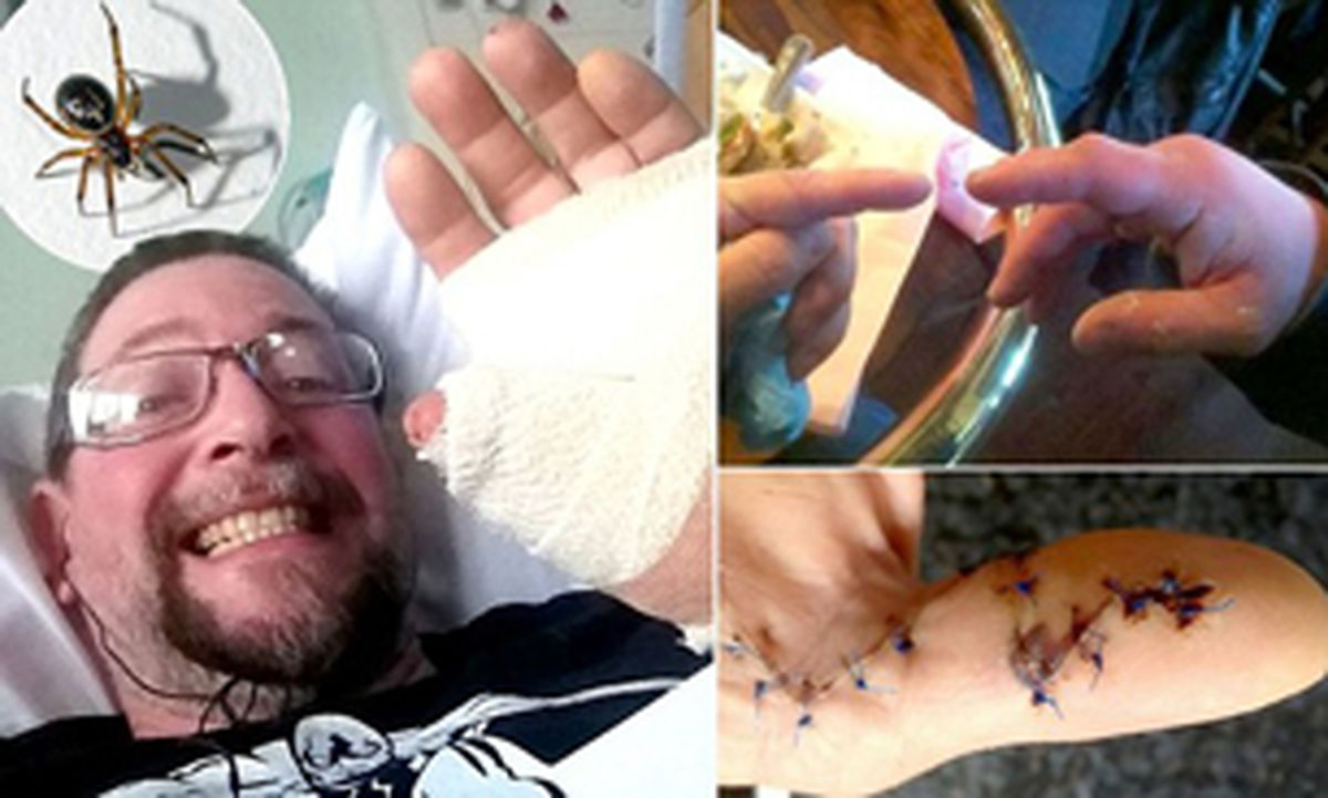 نیش‌عنکبوت‌دست انسان‌راقطع کرد/عکس