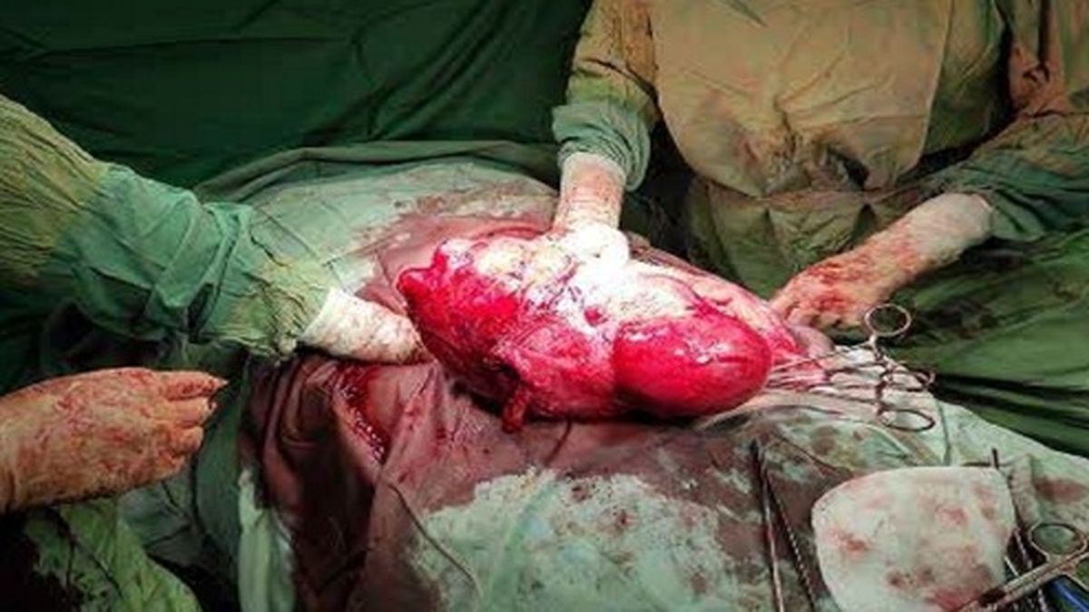 توده هفت کیلوگرمی در شکم یک بیمار قمی +عکس