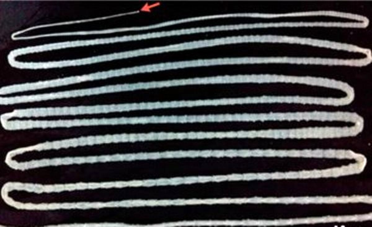 کشف کرم ۶ متری در بدن یک چینی+عکس