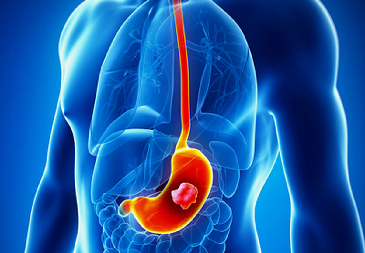 علائم و نشانه‌های سرطان معده را بشناسید