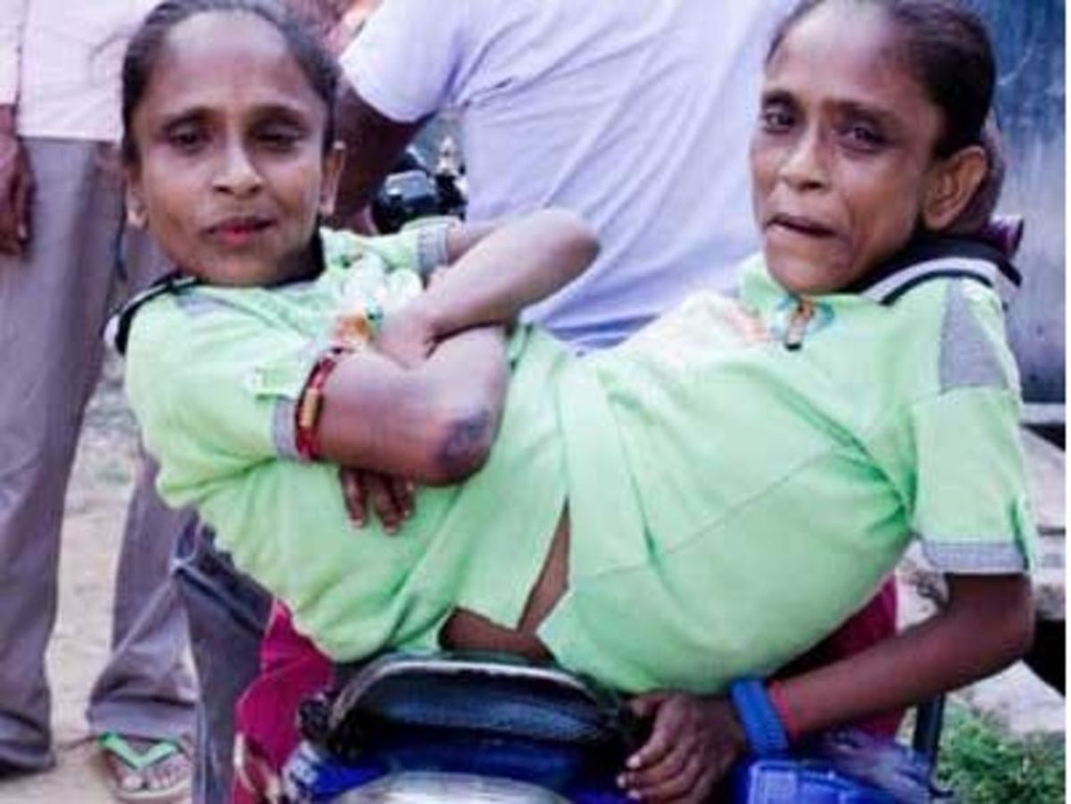 ازدواج جنجالی ۲ خواهر بهم چسبیده! +عکس