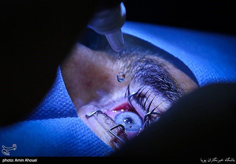 انجام روزانه ۶۰ عمل لیزیک توسط جراحان!