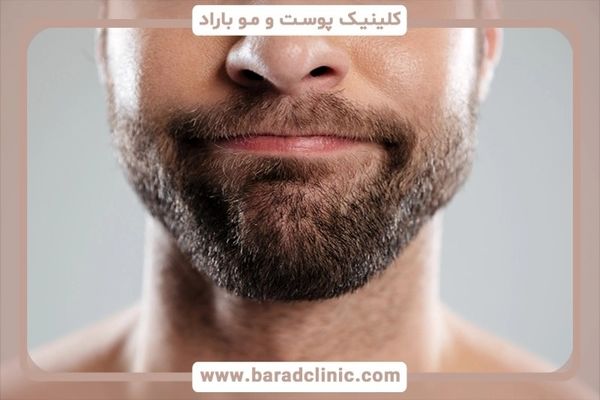 مراقبت‌های طلایی قبل از کاشت ریش راهنمای کامل برای نتیجه‌ای طبیعی و بی‌نقص