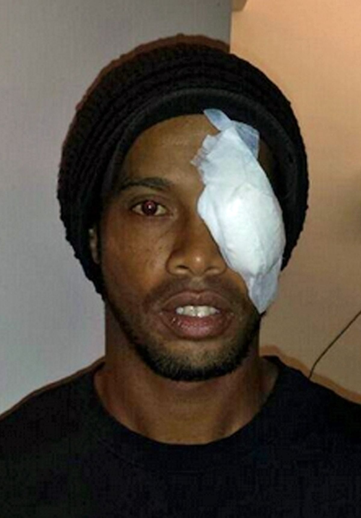 رونالدینیو، "یک چشم" شد!/عکس