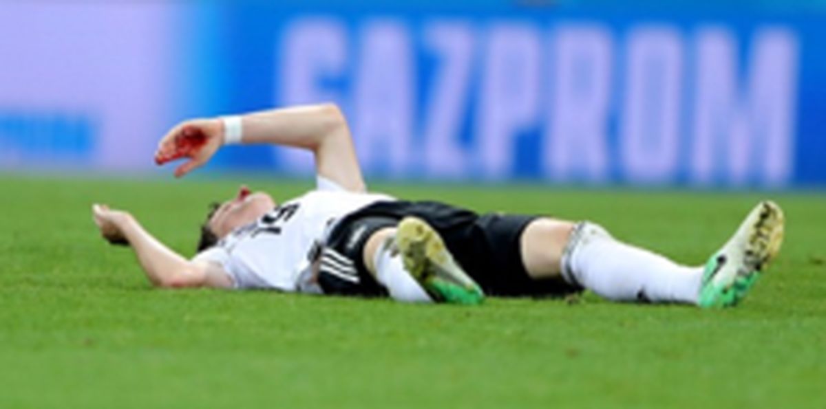 بینی هافبک آلمان شکست - خونریزی شدید رودی از ناحیه صورت