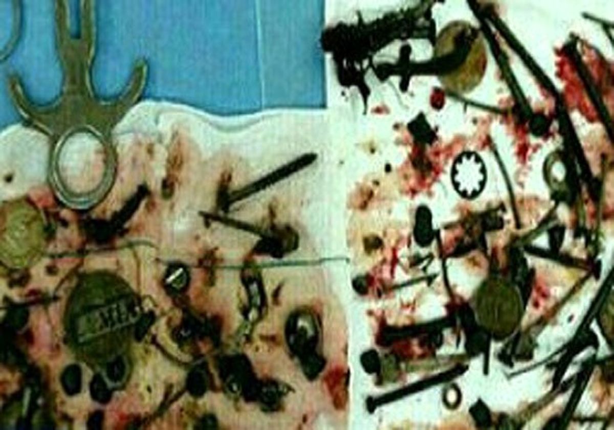 خارج کردن ۱۵۰ قطعه فلزی از شکم یک بیمار  +عکس