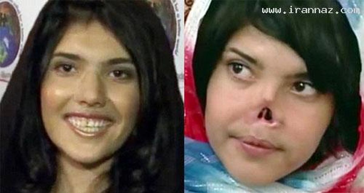 دختری که صاحب بینی شد! /عکس