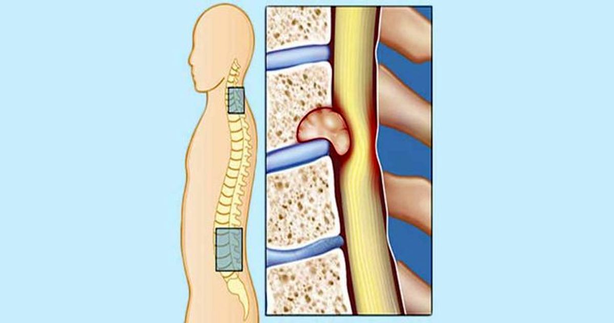 درمان تنگی کانال نخاع چطور ممکن است؟
