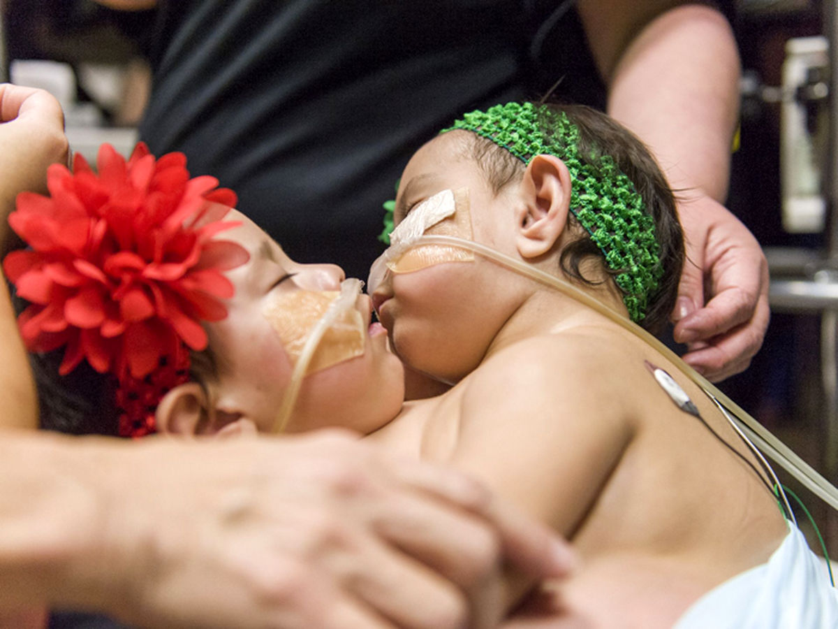 تصاویر پیچیده‌ترین عمل جداسازی دوقلوها