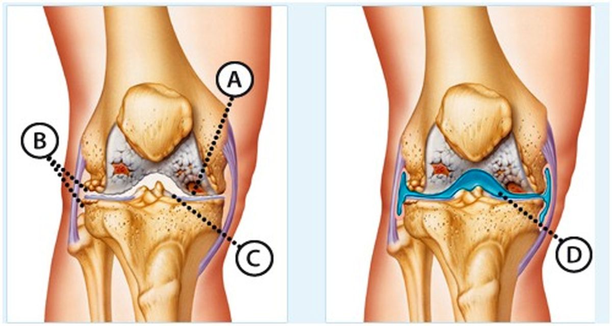 ورم زانو چیست و چه راه هایی برای درمان دارد