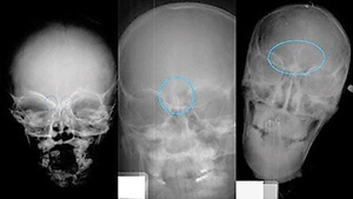 تعیین سن از روی اندازه سینوس! +عکس