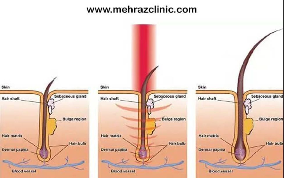 لیزر بدن چگونه بر روی موهای زائد اثر میگذارد؟ + ۵ نکته مهم لیزر دائمی کل بدن و حدفاصل هر جلسه لیزر