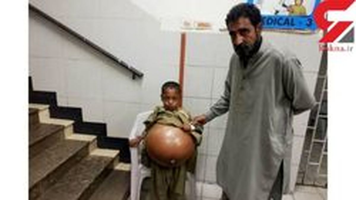 این پسر ۹ ساله عجیبترین درد را دارد! +عکس