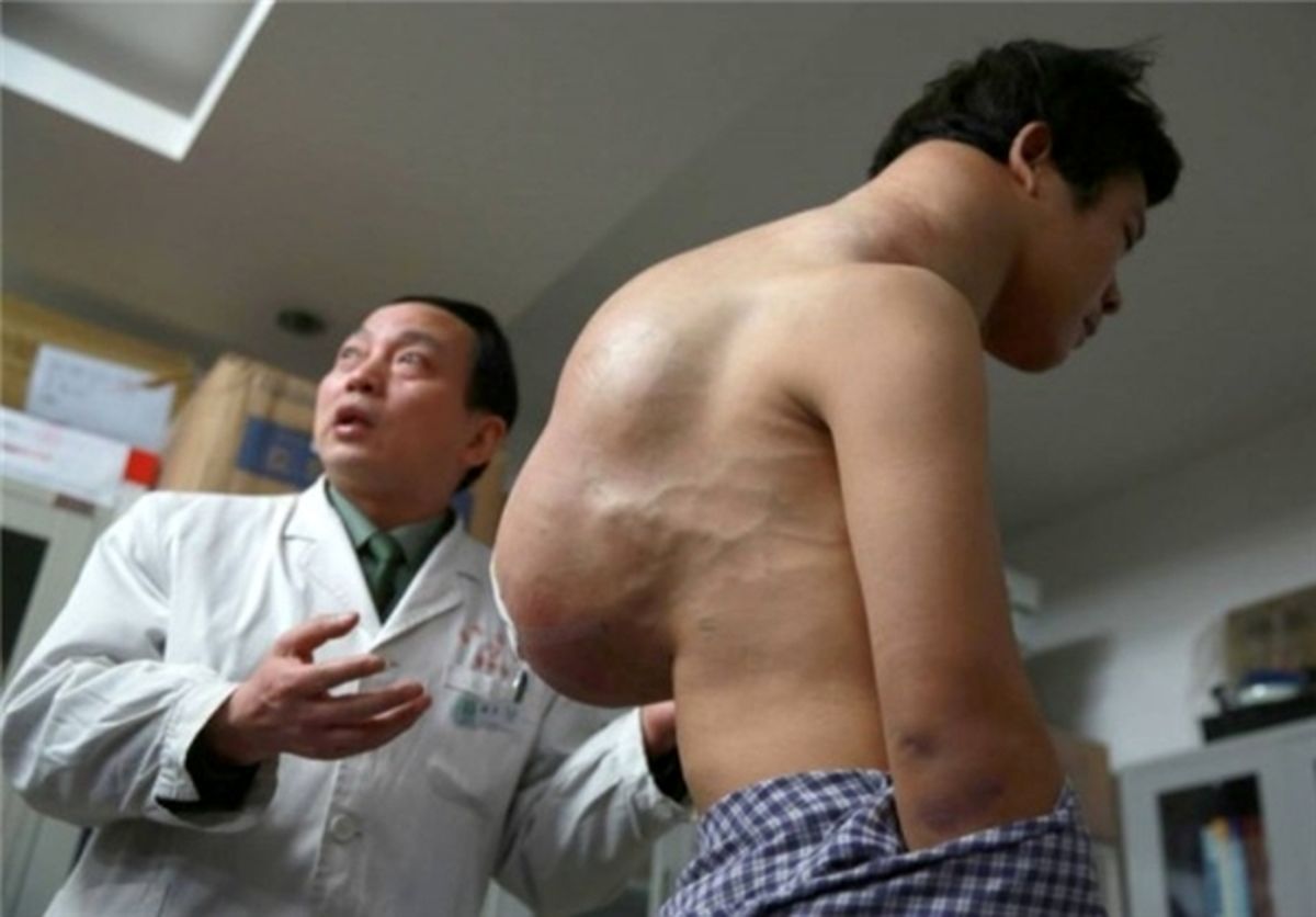 مردی با یک تومور ۱۰ کیلویی/عکس