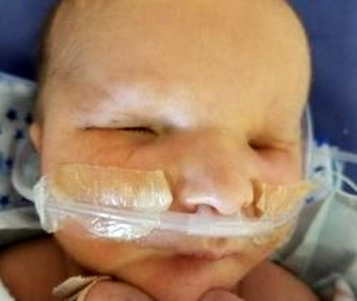 تولد نوزاد بدون چشم همه را شوکه کرد! +تصاویر