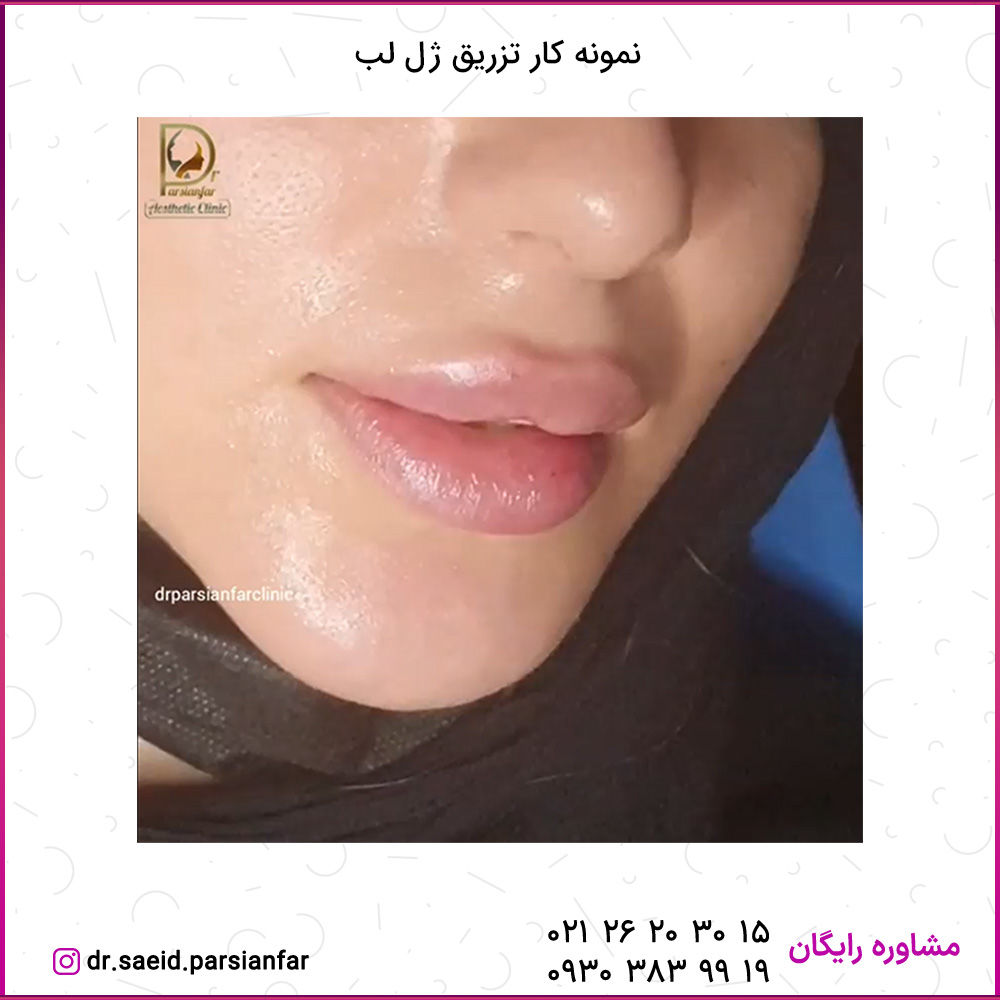 برای تزریق ژل لب به چه نکاتی باید توجه کنیم؟