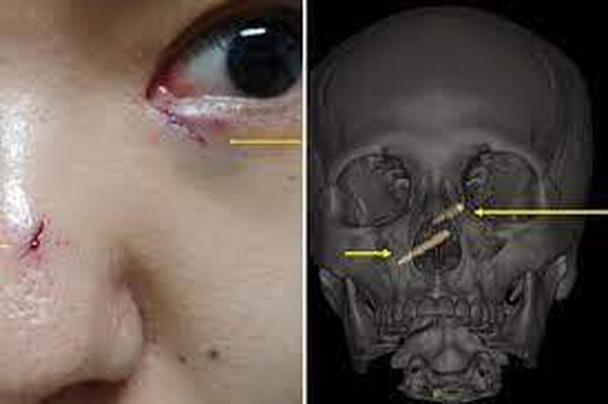 فرو رفتن چوب غذاخوری  در سر زن تایوانی! +عکس وحشتناک