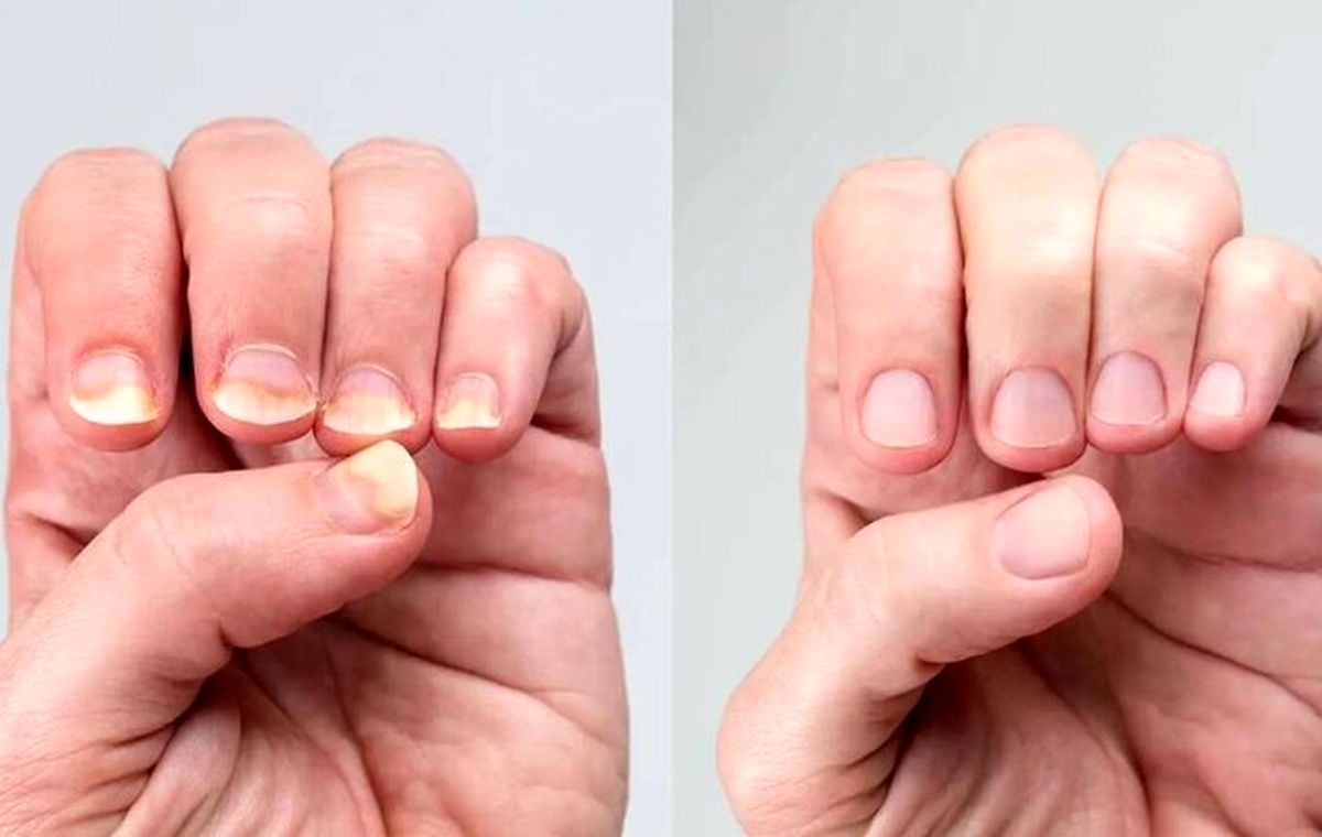 آیا سفیدی ناخن‌ها نشانه کم‌خونی است