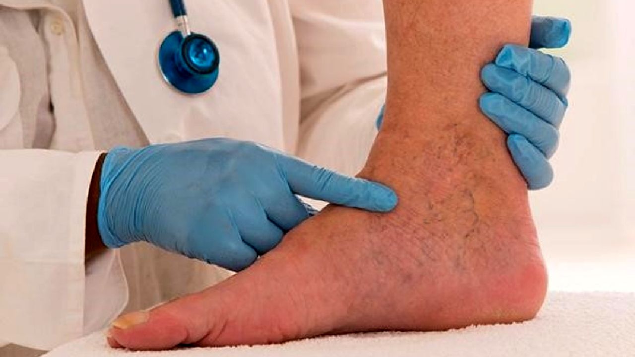 علائم واریس را بشناسید 