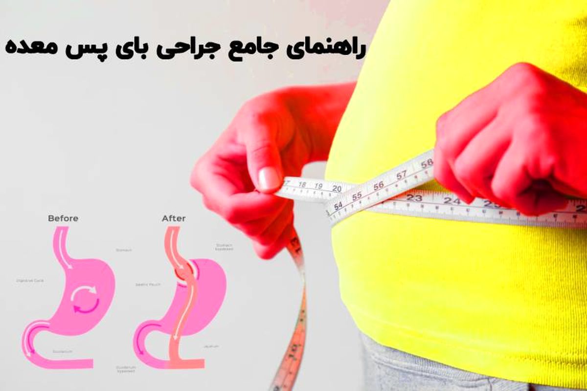 همه چیز درباره عمل بای پس معده (راهنمای جامع)