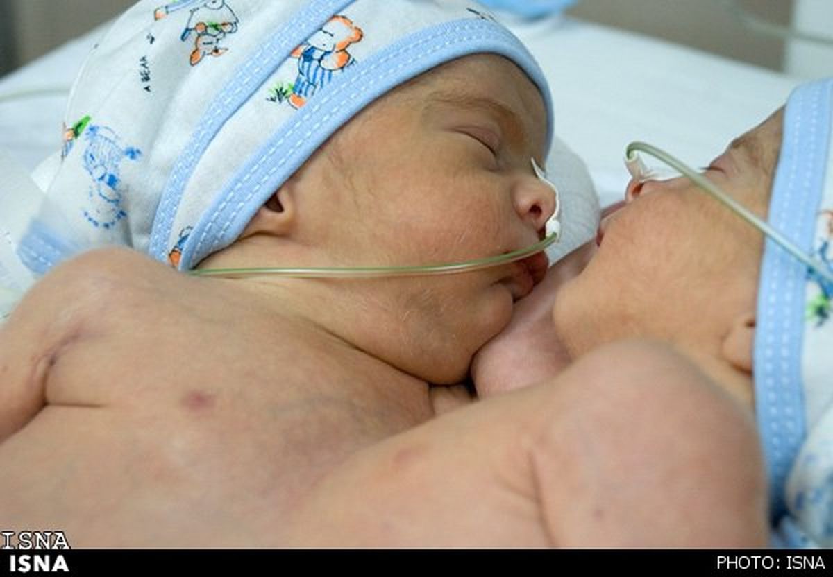 تولد دوقلوهای به هم چسبیده در شیراز