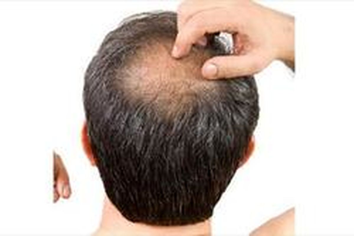 سیب زمینی سرخ کرده کچل می‌کند!