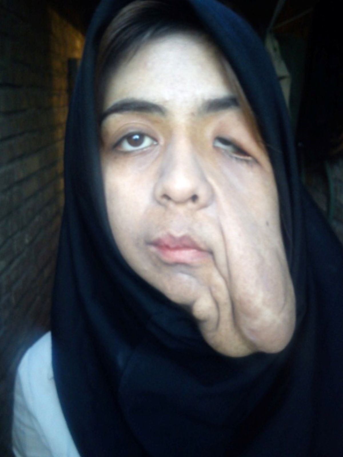 عکس/ درد بی‌درمان دختر 18 ساله