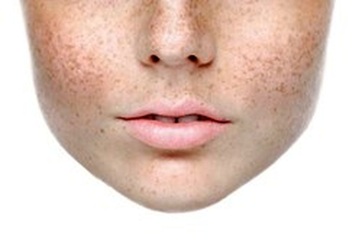 ۵ نکته‌ای که باید خانم‌ها در مورد لک پوستی بدانند