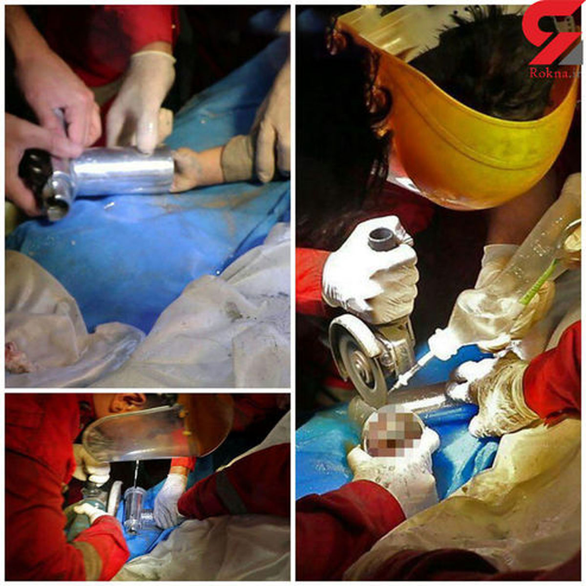 قطع شدن ۴ انگشت یک کودک مشهدی +عکس‌های تکاندهنده