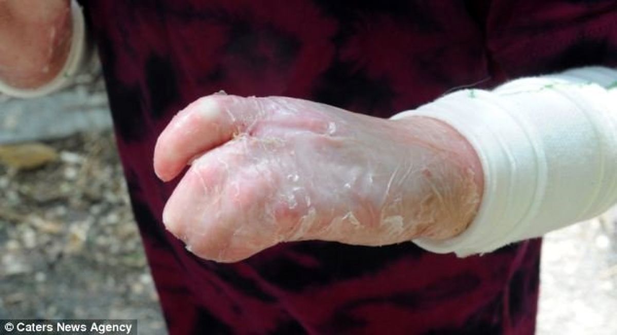 گم شدن ۲۵۰۰ کیلو پانسمان بیماران پروانه‌ای!/ مجلس ورود کرد