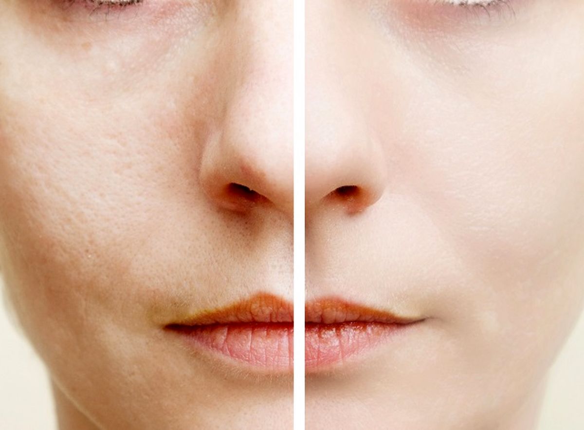 ۳ درمان خانگی برای منافذ باز شده‌ پوست